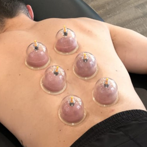 Cupping Therapy Baton Rouge, LA